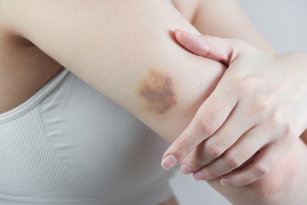 แผลฟกช้ำ bruise