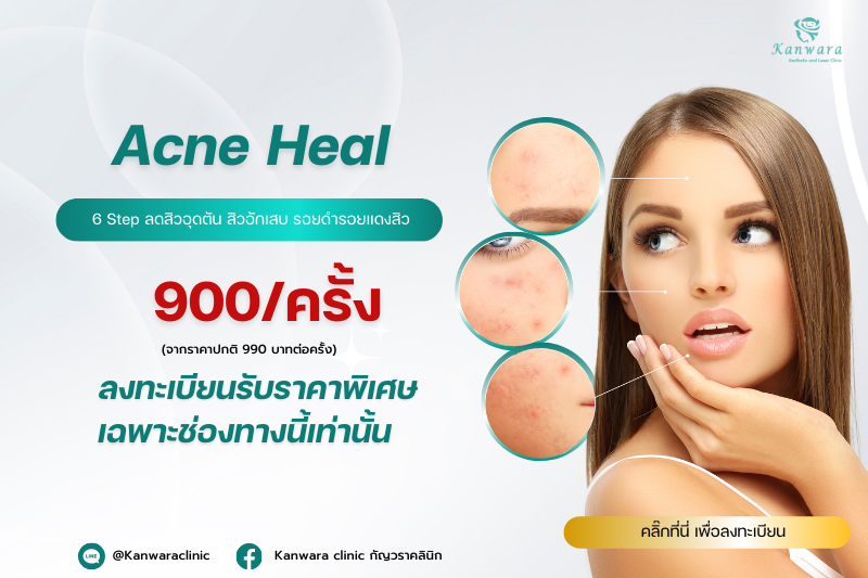 Acne-Heal