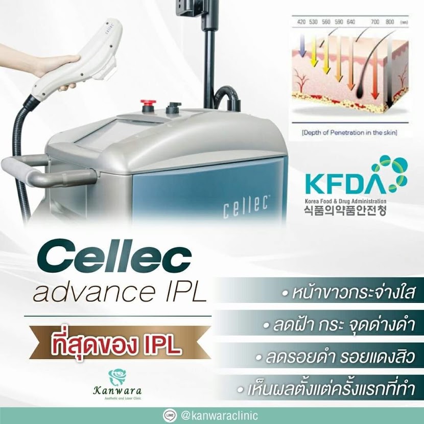 cellec-acne-laser-IPL